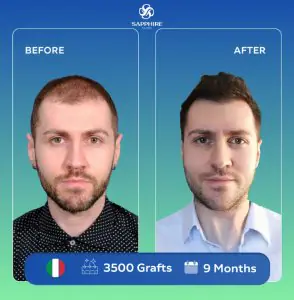 Trasplante capilar en Sapphire Hair Clinic antes y después, 3500 injertos, 9 meses