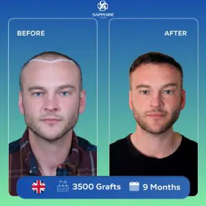 Resultados antes y después de trasplante capilar en Sapphire Hair Clinic, 3500 injertos en 9 meses