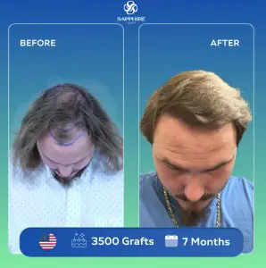 Trasplante capilar en Sapphire Hair Clinic antes y después, 3500 injertos, 7 meses