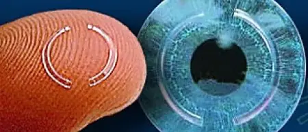 Segmento de anillo corneal intrastromal para queratocono en la clínica Prof. Or Kaiserman
