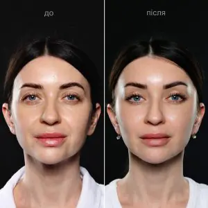 نتائج قبل وبعد تجميل الوجه في عيادة Vidnova