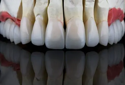 نموذج قشور وتيجان الأسنان في Dr. Han Dental Lounge