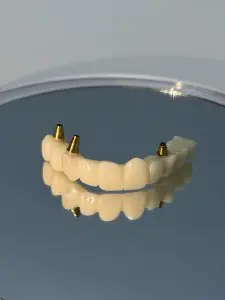 جسر زراعة الأسنان مع الدعائم في Legacy Dental Clinics