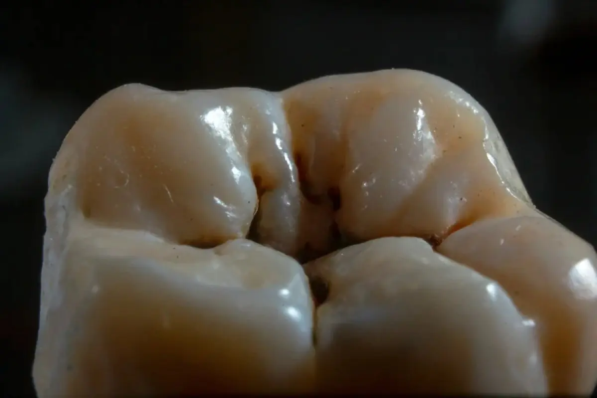 Close-up of molar tooth with visible dental caries at Sunrise Dental Clinic
