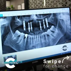 Radiografía de implantes dentales en monitor en la clínica Contenturkey, Turquía