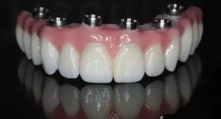 جسر زرع الأسنان في Dental Premier High Tech Dentistry، جهاز تعويضي متقدم