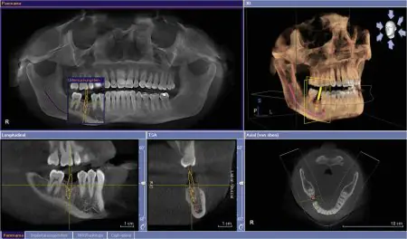 تصوير أشعة سينية رقمية ثلاثية الأبعاد للتخطيط لزراعة الأسنان في Dental Premier