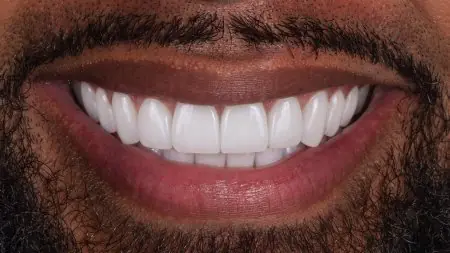 صورة مقربة لنتيجة عدسات الأسنان في عيادة داريا لطب الأسنان