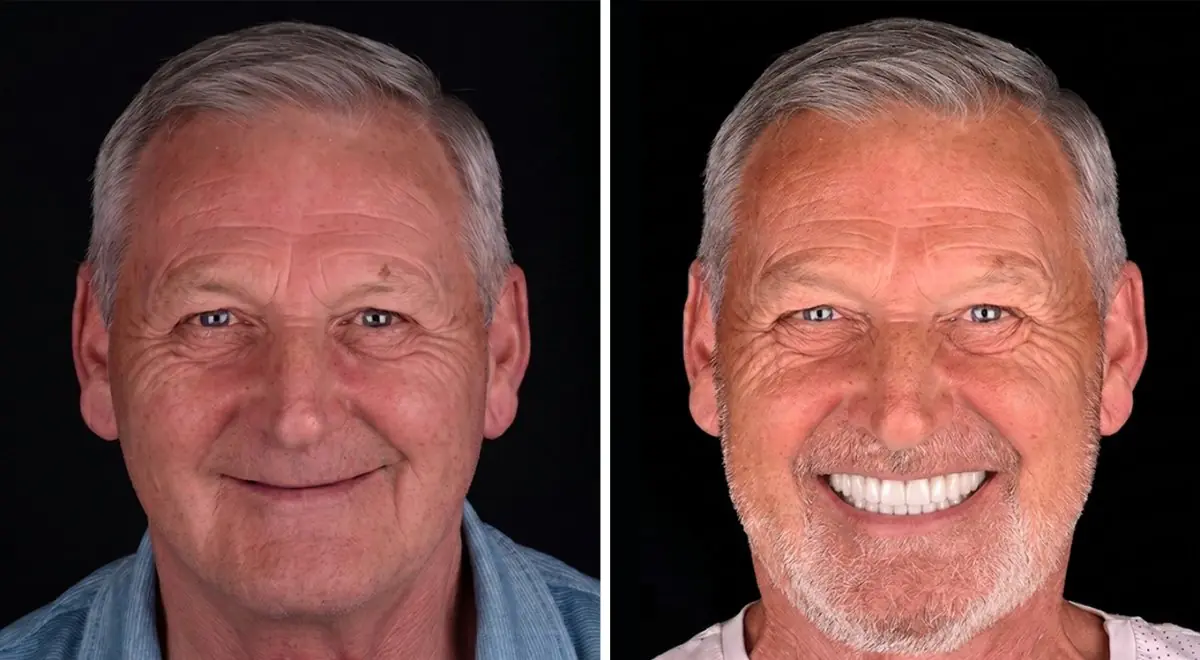 Before and after dental implants at VBright Dental clinic