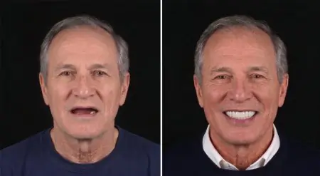 قبل وبعد زراعة الأسنان في عيادة VBright Dental