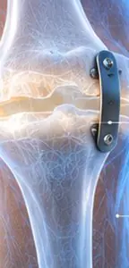 أشعة سينية لمفصل الركبة مع زرع تقويم العظام في عيادة Dr. Ahmed Gadallah