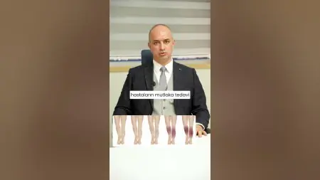 طبيب في Özel Medline Adana Hastanesi يشرح خيارات علاج الدوالي