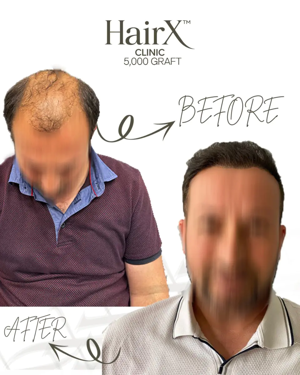 Résultats avant et après greffe de cheveux à la clinique HairX, procédure 5 000 greffons
