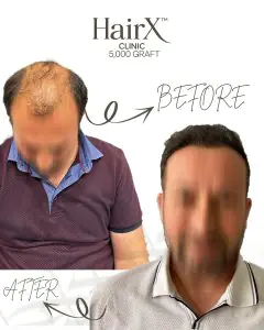 Resultados antes y después de trasplante capilar en HairX Clinic, procedimiento de 5,000 injertos