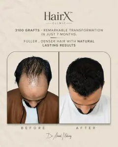 Resultados antes y después de trasplante capilar en HairX Clinic, 3100 injertos en 7 meses