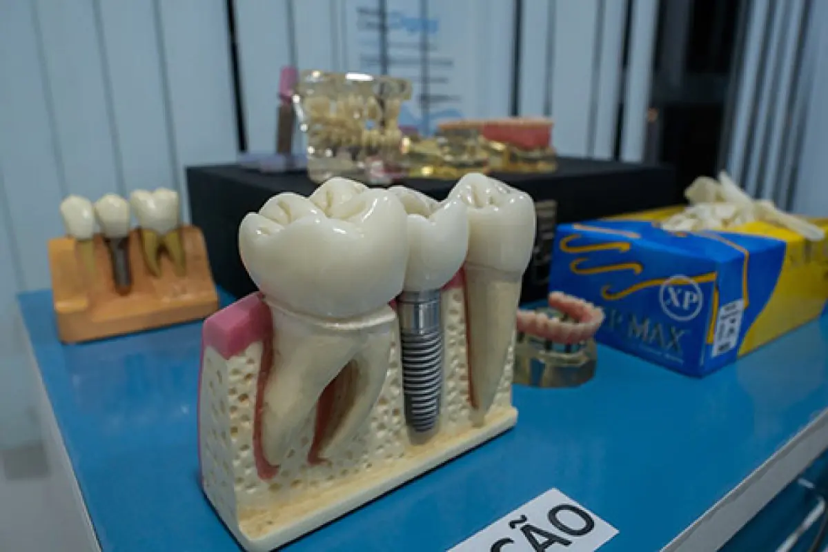 Dental implant model and prosthetic teeth at Oral 360 clinic