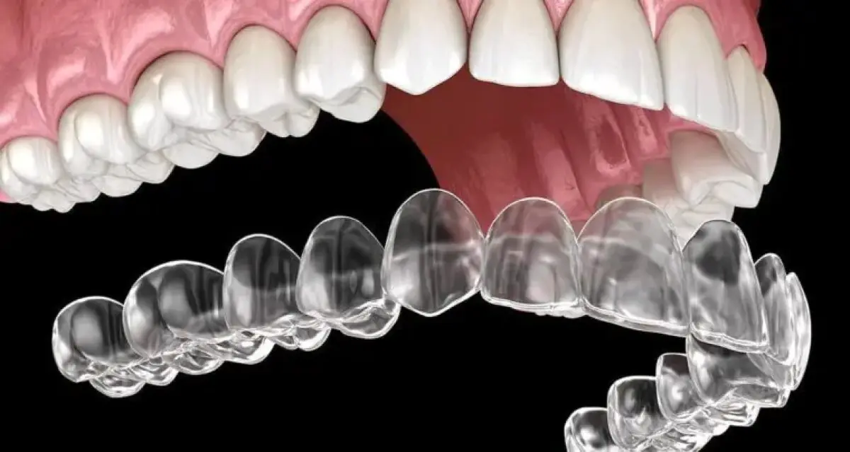 Aligneur dentaire transparent pour traitement orthodontique chez Clínicas White S.A.S.