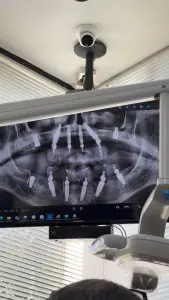Radiografía de implantes dentales en monitor en Perfect Smile Dental