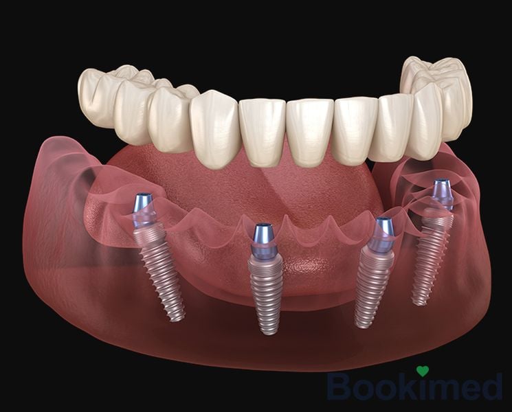 all-on-4-dental-implants