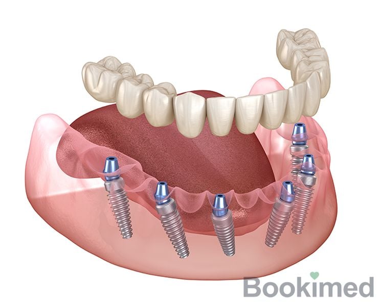 all-on-6-dental-implants