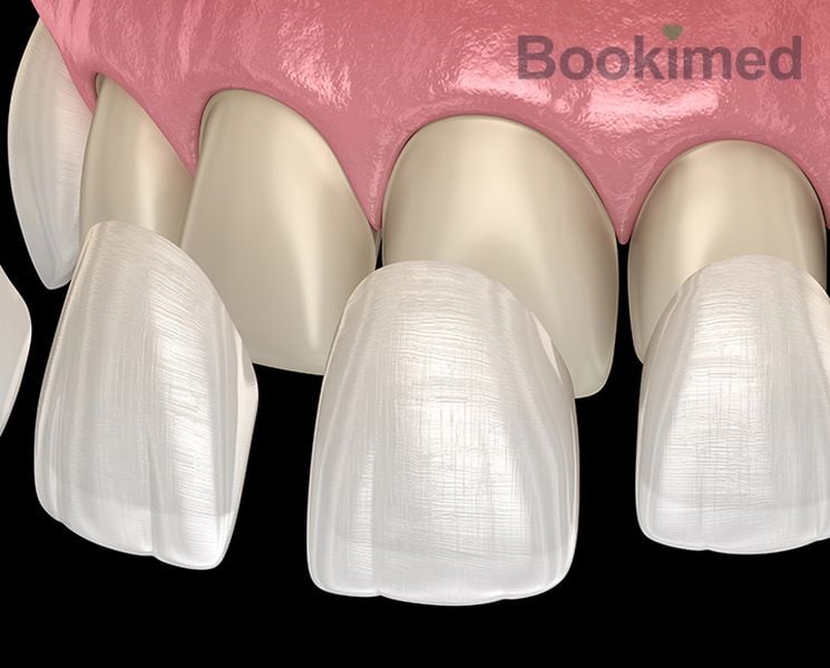 composite-veneer