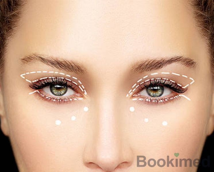 double-eyelid-creation
