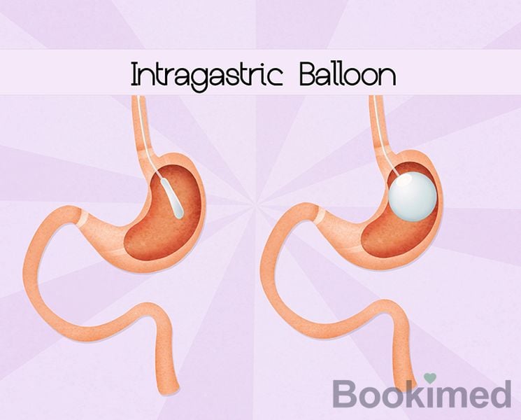 Balón gástrico en Polonia – Costos y Paquetes 2025