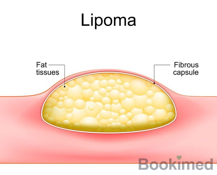 lipoma-removal