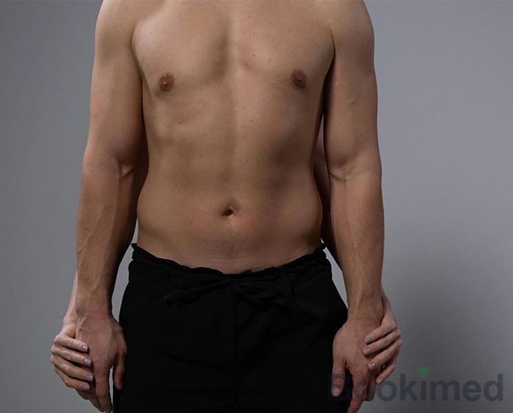 liposuction-for-gynecomastia