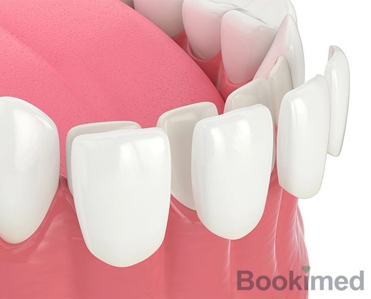 porcelain-veneer