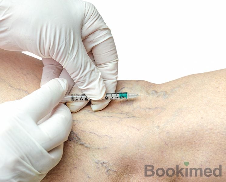 sclerotherapy-of-varicose-veins