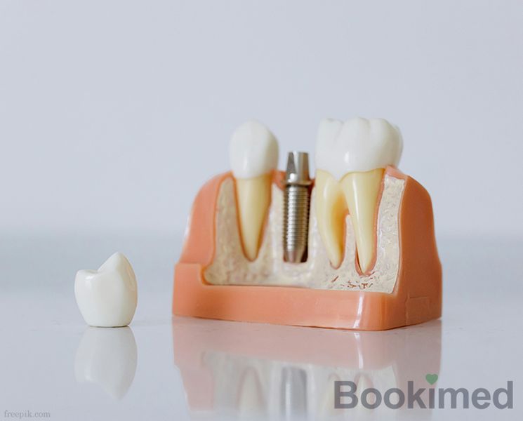 straumann-dental-implants