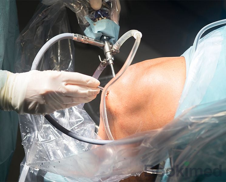 therapeutic-arthroscopy-of-the-knee--including-the-necessary-supplies