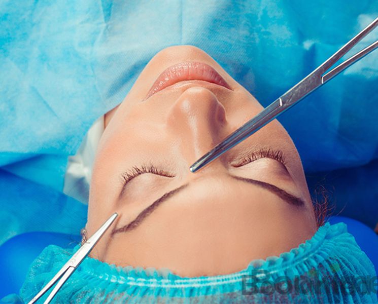 upper-eyelid-surgery