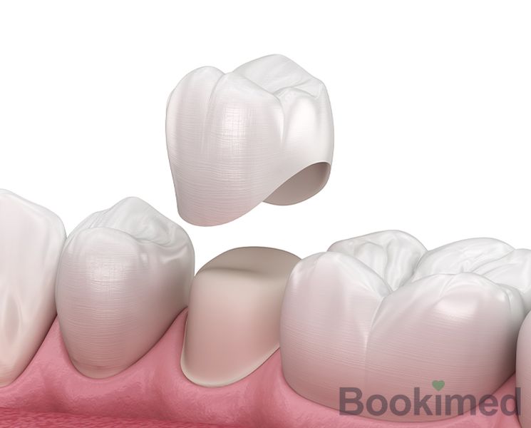 zirconia-crown-installation