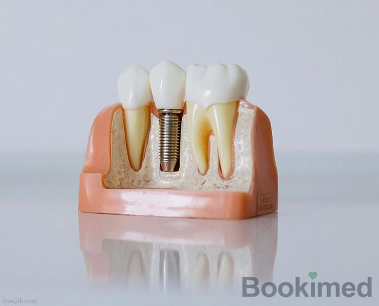 zygomatic-implant