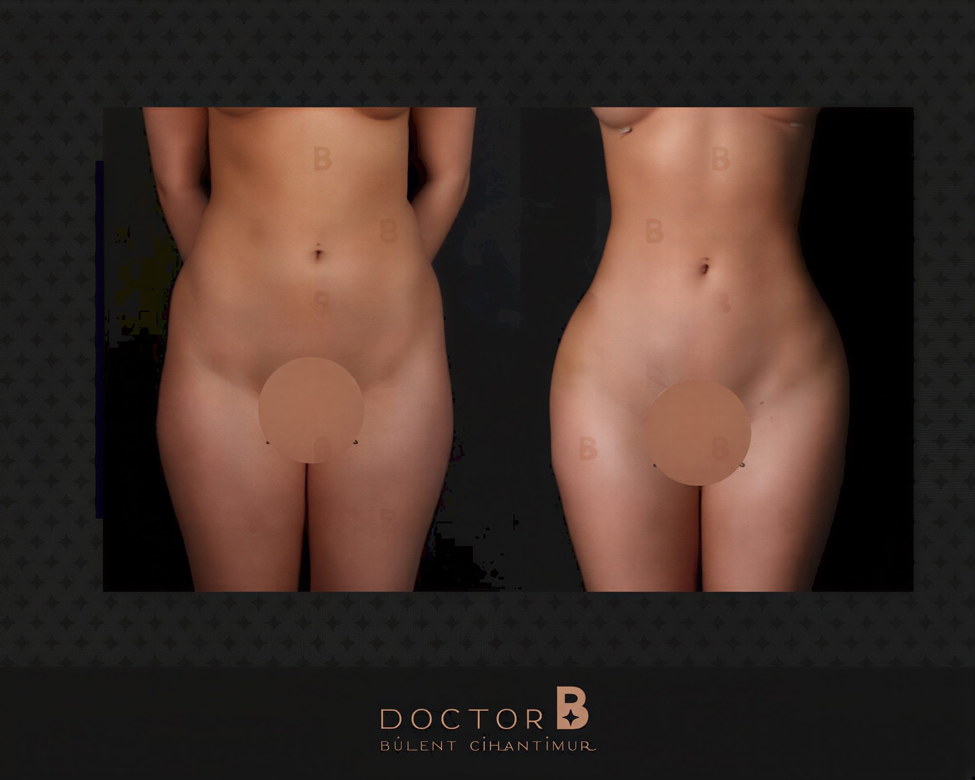 نتائج شفط الدهون قبل وبعد في Doctor B Clinic، تحسين واضح لتناسق الجسم
