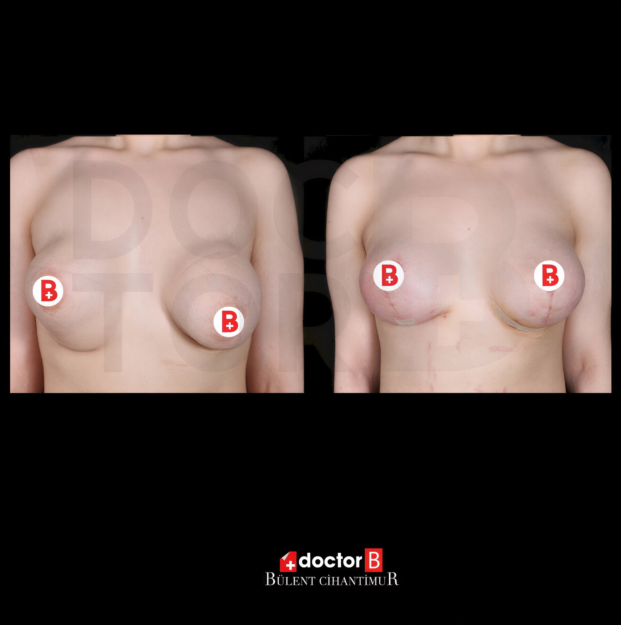 Resultados de lifting de senos antes y después en Doctor B Clinic, mejora visible del contorno