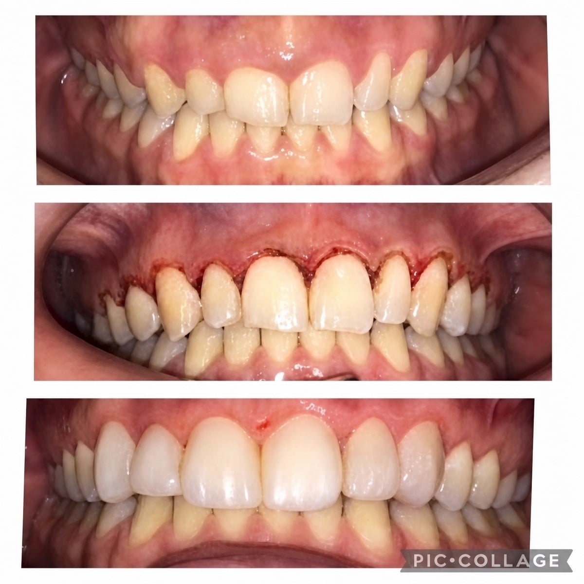 Resultados antes y después de carillas de composite en Professional Dental Care Clinic, sonrisa renovada