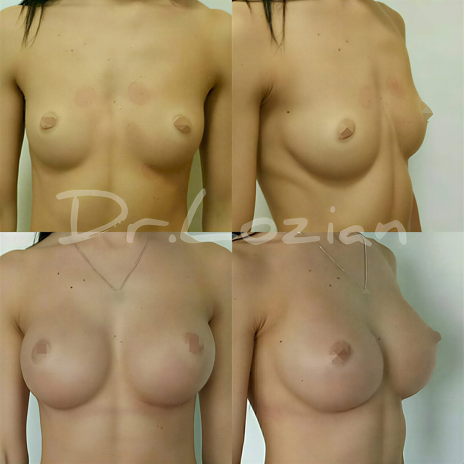 Resultados de mamoplastia antes y después en Oleg Kolibaba Medical Center, aumento de senos