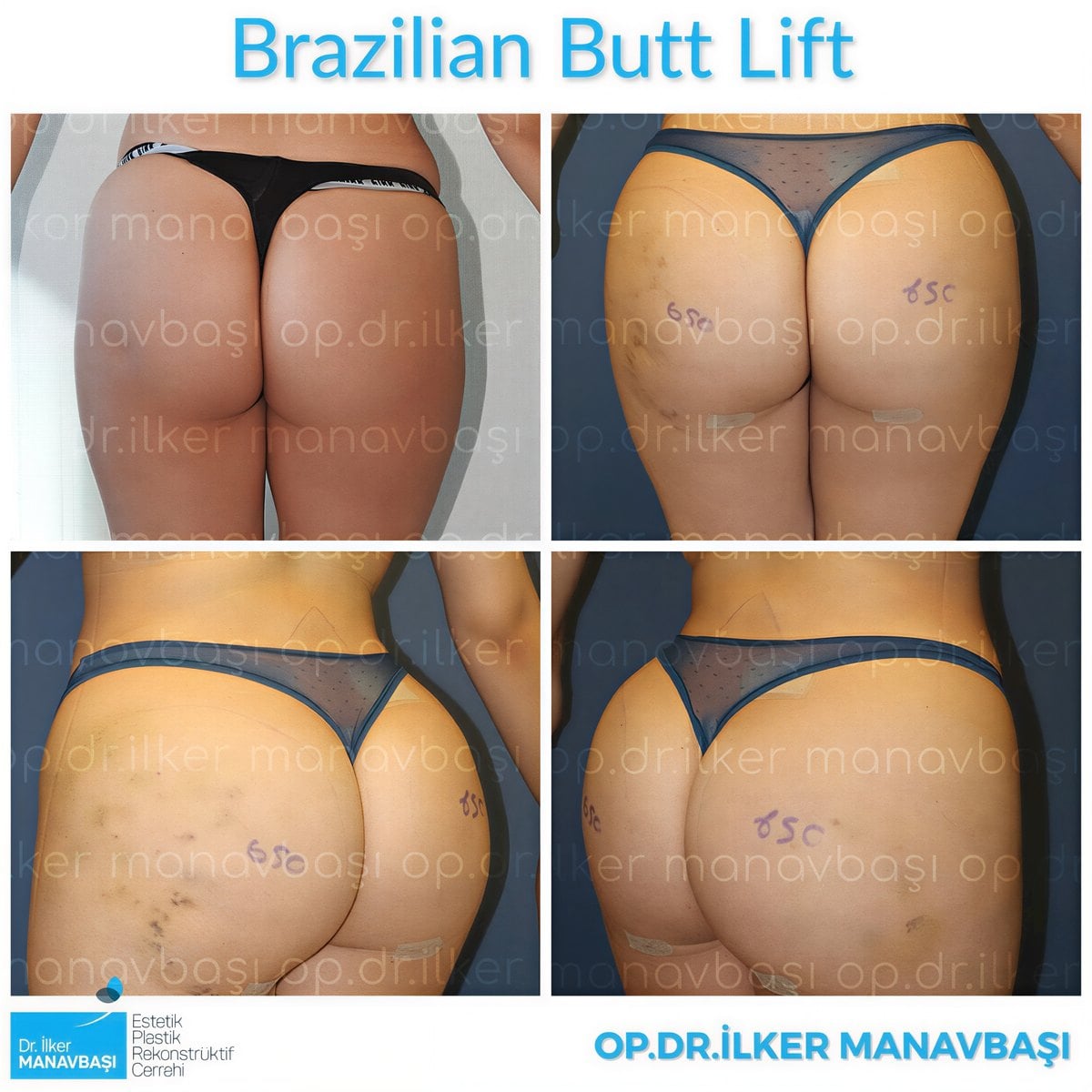 Resultados antes y después de Brazilian Butt Lift en la clínica Dr. Ilker Manavbasi