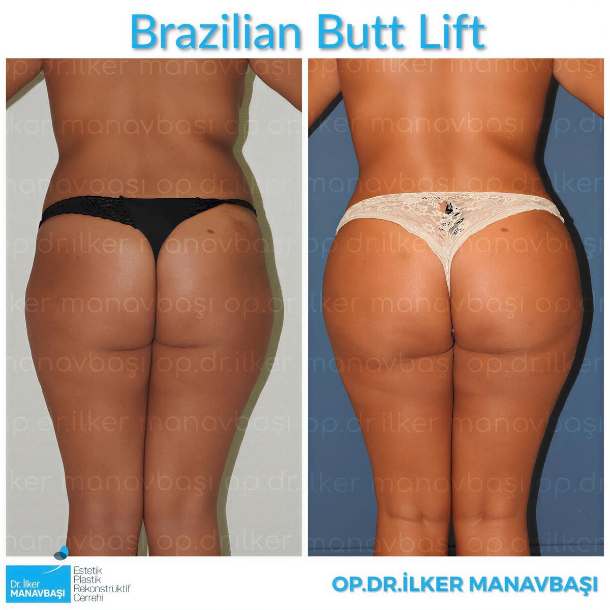 Resultados antes y después de Brazilian Butt Lift en la clínica Dr. Ilker Manavbasi, mejor contorno