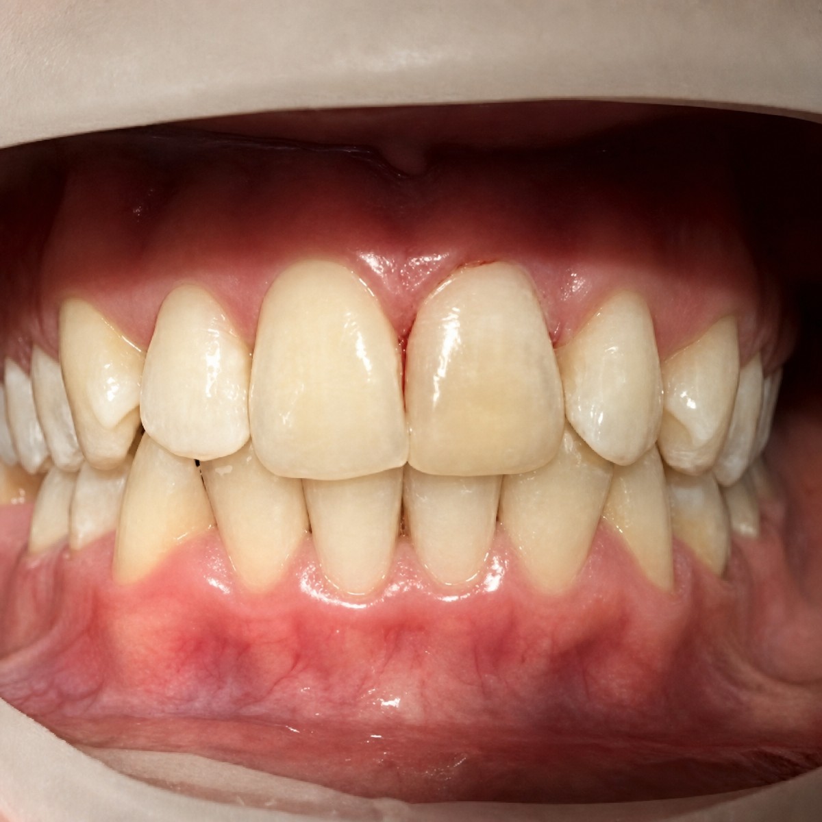نتيجة قشور الكمبوزيت في عيادة NGY Med Dental – تحسين شكل ولون الأسنان