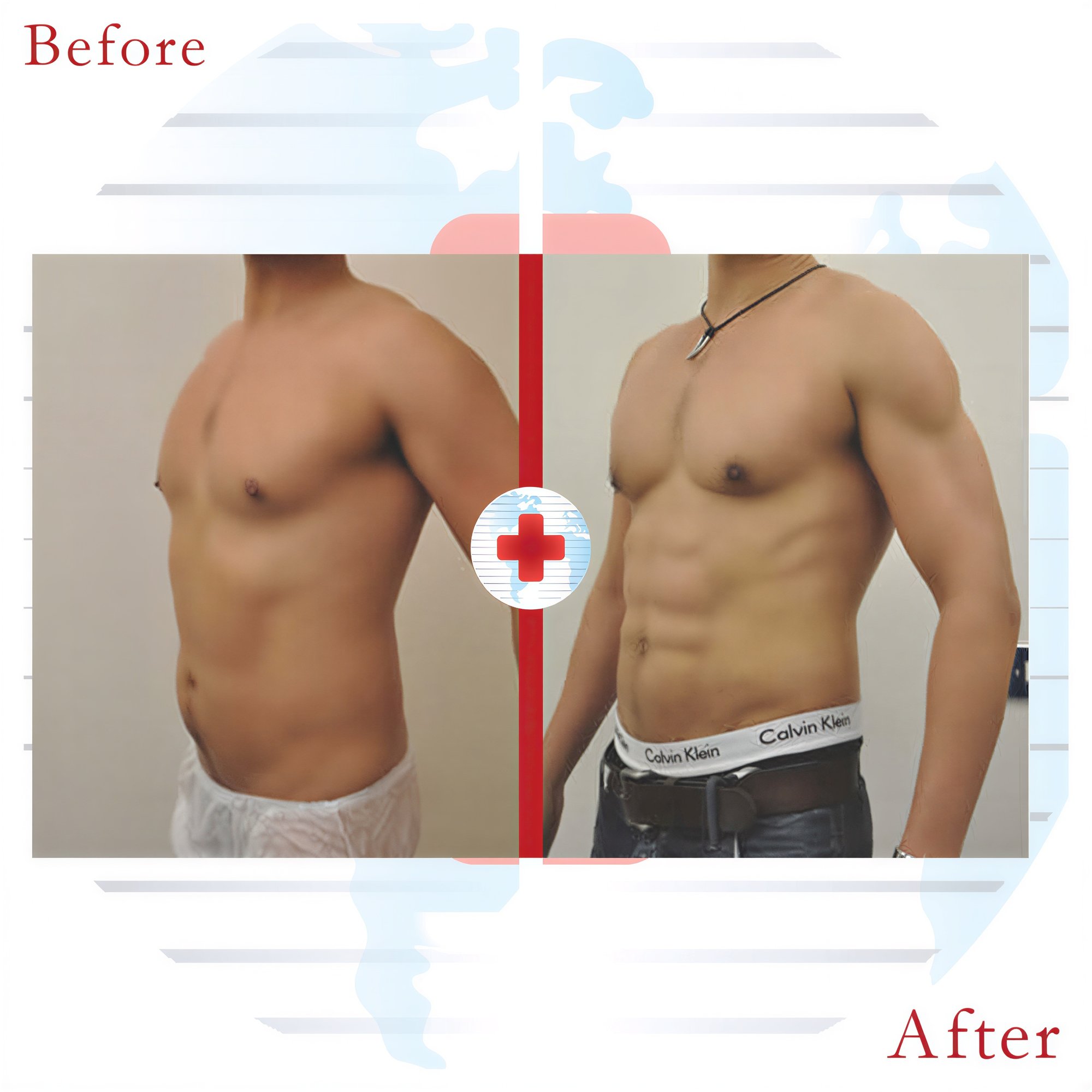 Resultados de liposucción abdominal antes y después en Clinics United, mejor contorno corporal