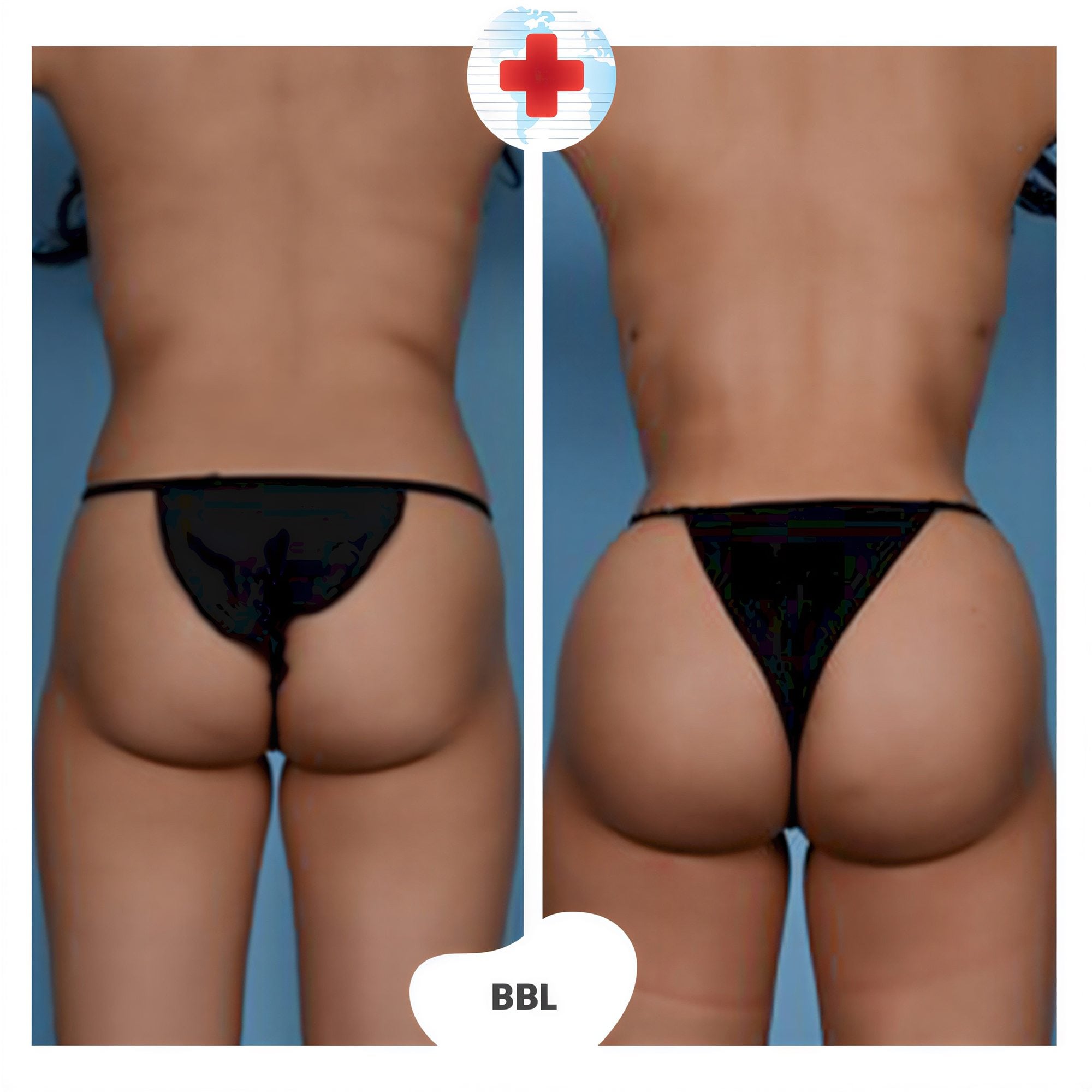 Resultados antes y después de Brazilian Butt Lift en Clinics United, glúteos realzados