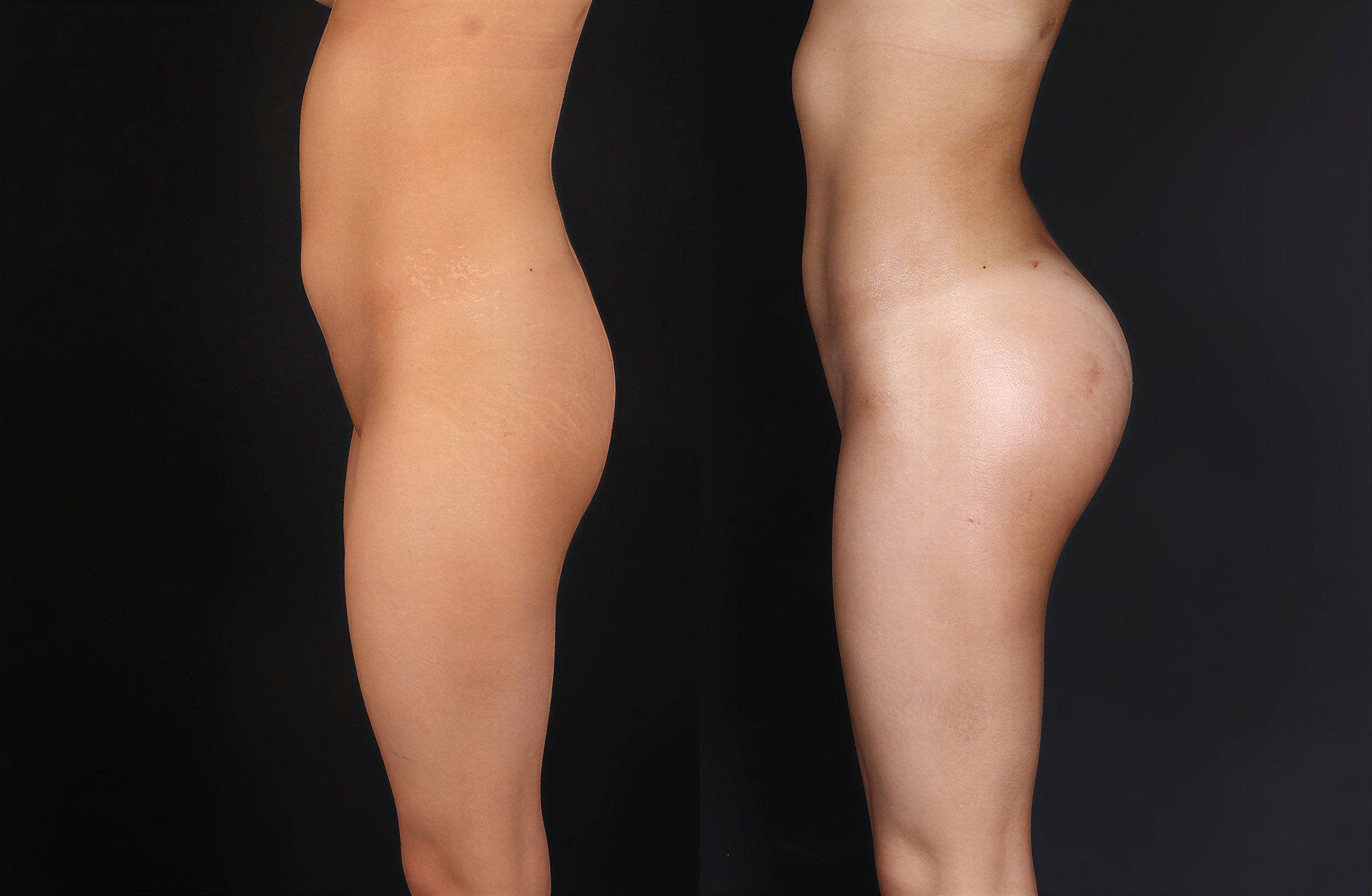 Resultados de lifting de glúteos antes y después en Dr Selcuk Aytac Clinic, mejor contorno