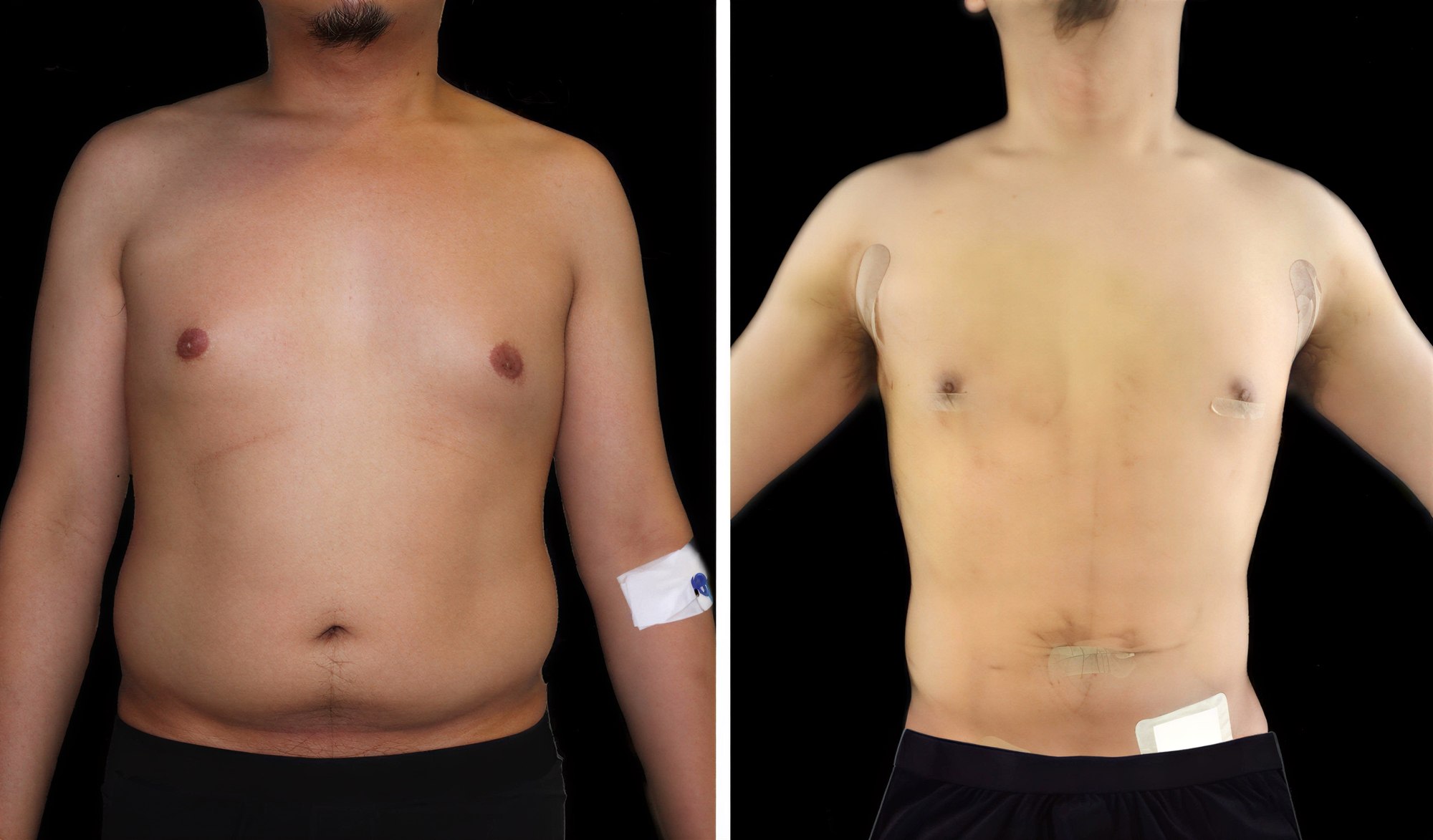 Resultados de abdominoplastia y liposucción antes y después en la clínica Dr. Ilker Manavbasi