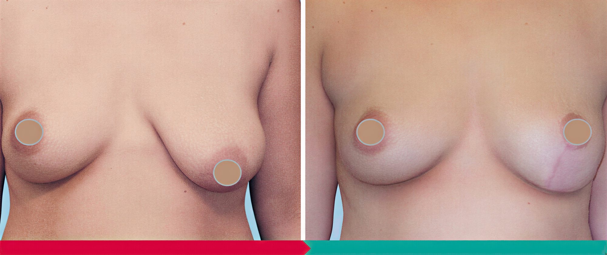 Resultados de lifting de senos antes y después en ABClinic Art & Beauty – mejor contorno