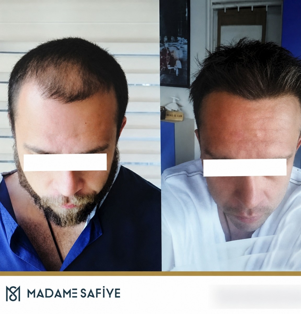 Resultados antes y después de trasplante capilar DHI en Madame Safiye Clinic, mayor densidad
