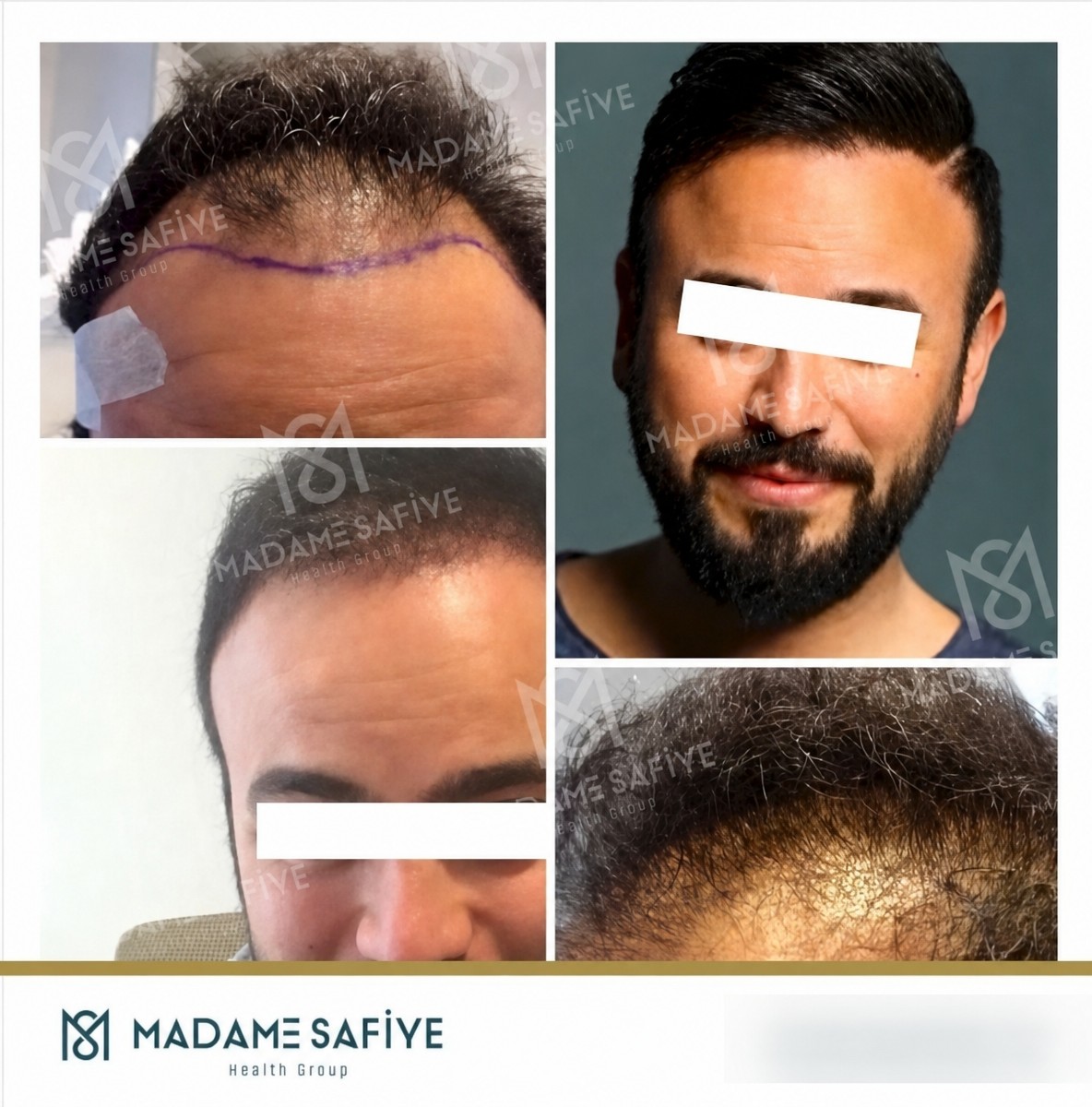 نتائج زراعة الشعر FUE قبل وبعد في عيادة Madame Safiye، استعادة خط الشعر للرجال